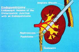 Endopyelotomy