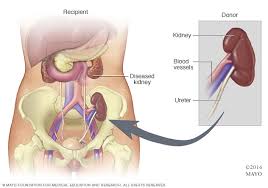 Kidney Transplant Surgery