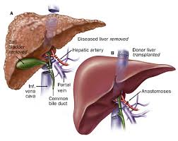 Liver Transplant Surgery