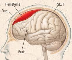 Chronic Subdural Haematoma