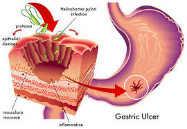 Stomach Cancer Treatment