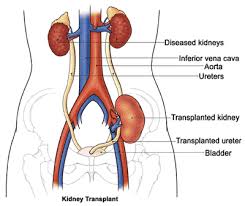 Kidney Transplant Surgery