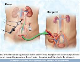 Kidney Transplant Surgery