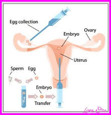 In Vitro Maturation Treatment