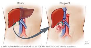 Liver Transplant Surgery