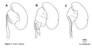 Endopyelotomy