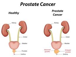 Robotic Prostate Cancer Surgery