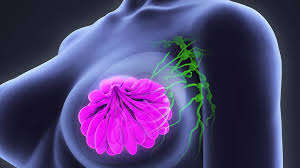 Breast Cancer Treatment