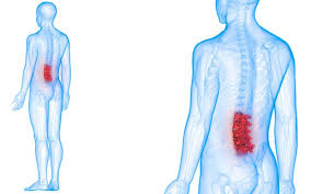 Spinal Fusion and Decompression