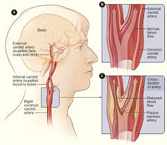 Endovascular Neurosurgery