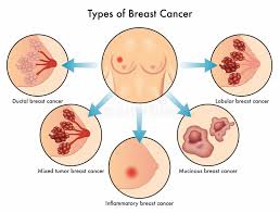 Breast Cancer Treatment