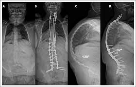 Spinal Fusion and Decompression