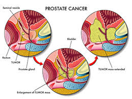 Robotic Prostate Cancer Surgery