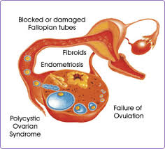 IVF