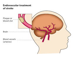 Endovascular Neurosurgery