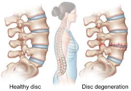 Spinal Fusion and Decompression