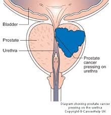 Robotic Prostate Cancer Surgery