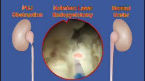 Endopyelotomy