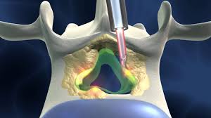 Spinal Stenosis surgery