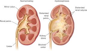 Laparoscopic Pyeloplasty