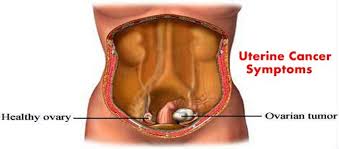 Uterine Cancer Treatment