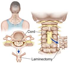 Spinal Stenosis surgery