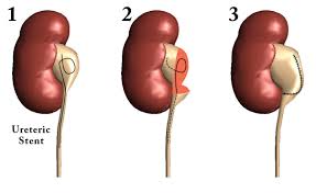 Laparoscopic Pyeloplasty