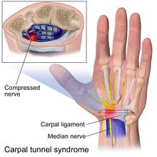 Carpal Tunnel Release Surgery