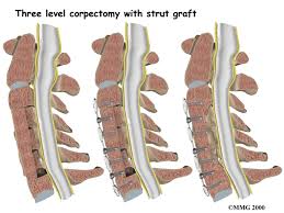 Spinal Stenosis surgery