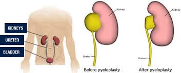 Laparoscopic Pyeloplasty