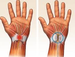 Carpal Tunnel Release Surgery