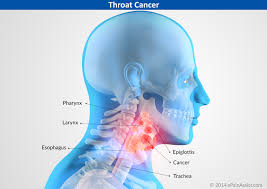 Head and Neck Cancer Treatment