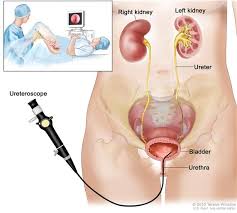 Endopyelotomy