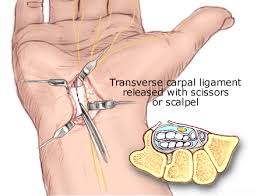 Carpal Tunnel Release Surgery