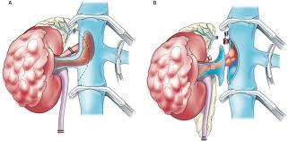 Laparoscopic Radical Nephrectomy