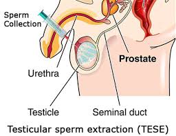 Testicular Sperm Extraction