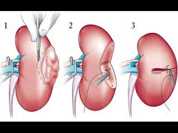 Laparoscopic Radical Nephrectomy