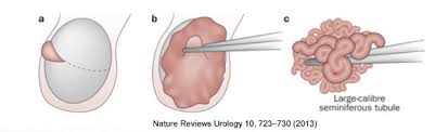 Testicular Sperm Extraction