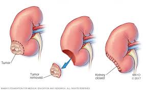 Laparoscopic Radical Nephrectomy