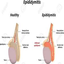 Testicular Sperm Extraction