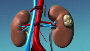 Laparoscopic Radical Nephrectomy