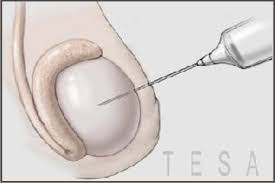 Testicular Sperm Extraction