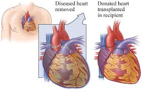 Heart Transplant Surgery