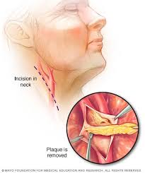 Carotid Endarterectomy