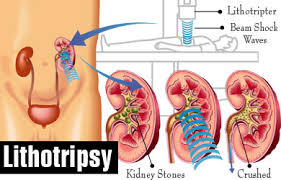 Laser Stone Removal