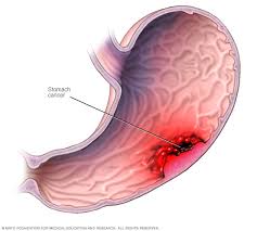 Stomach Cancer Treatment