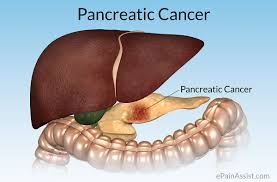 Pancreatic Cancer Treatment