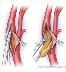 Carotid Endarterectomy