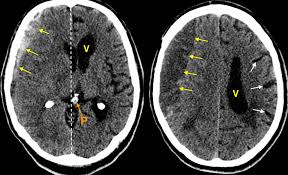 Chronic Subdural Haematoma