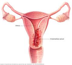 Uterine Cancer Treatment